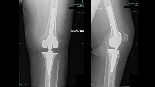 visual_traumacad_knee_story_2.jpg