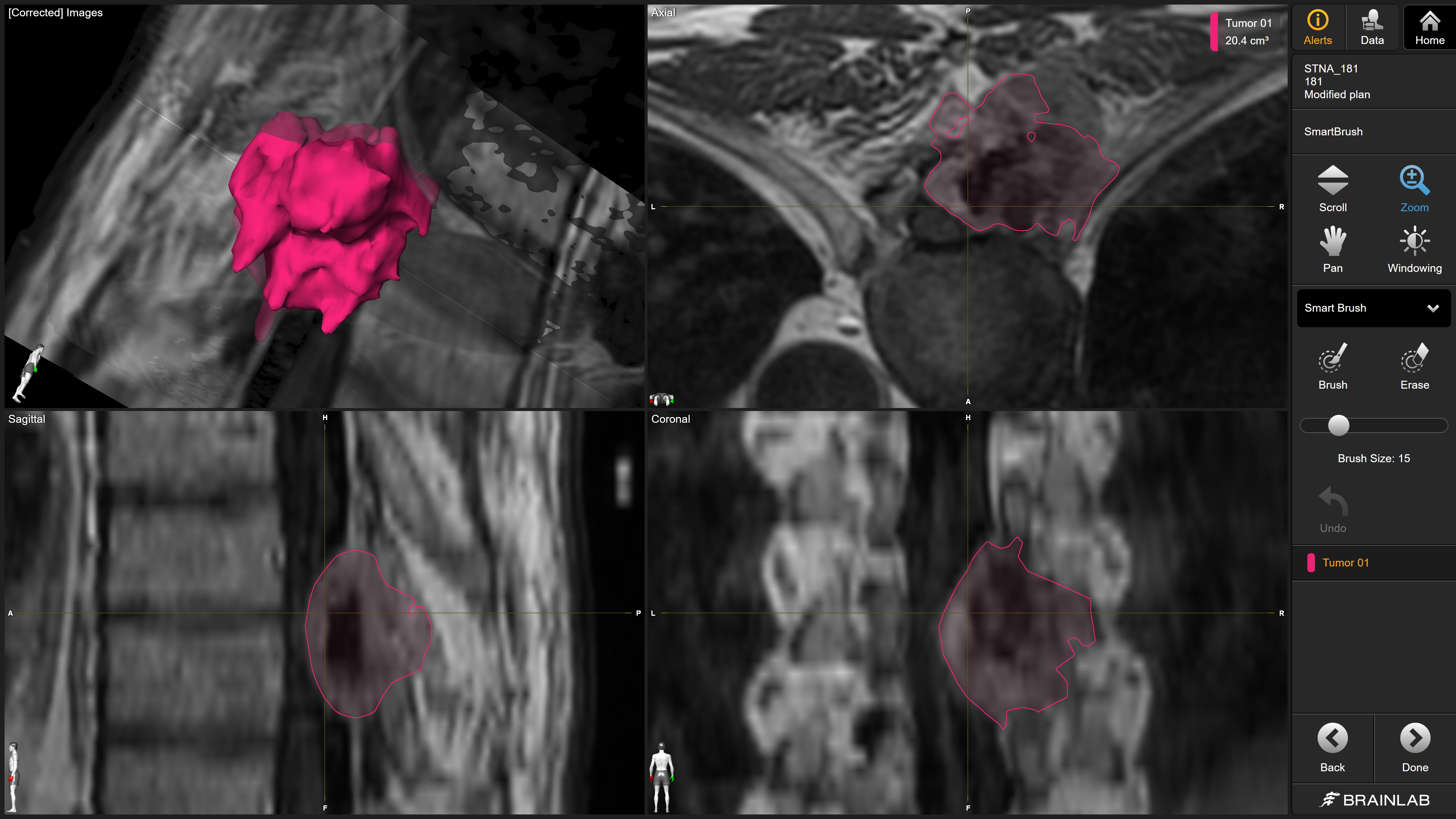 【裁断済】脊椎手術パーフェクト SPINE 61QuB+NY3KL._UF894,1000_QL80_.jpg