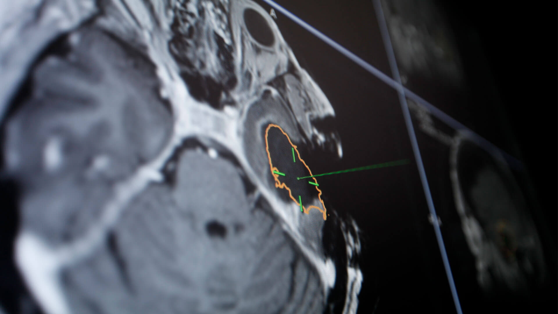 Cranial Navigation: Advanced Neuronavigation | Brainlab