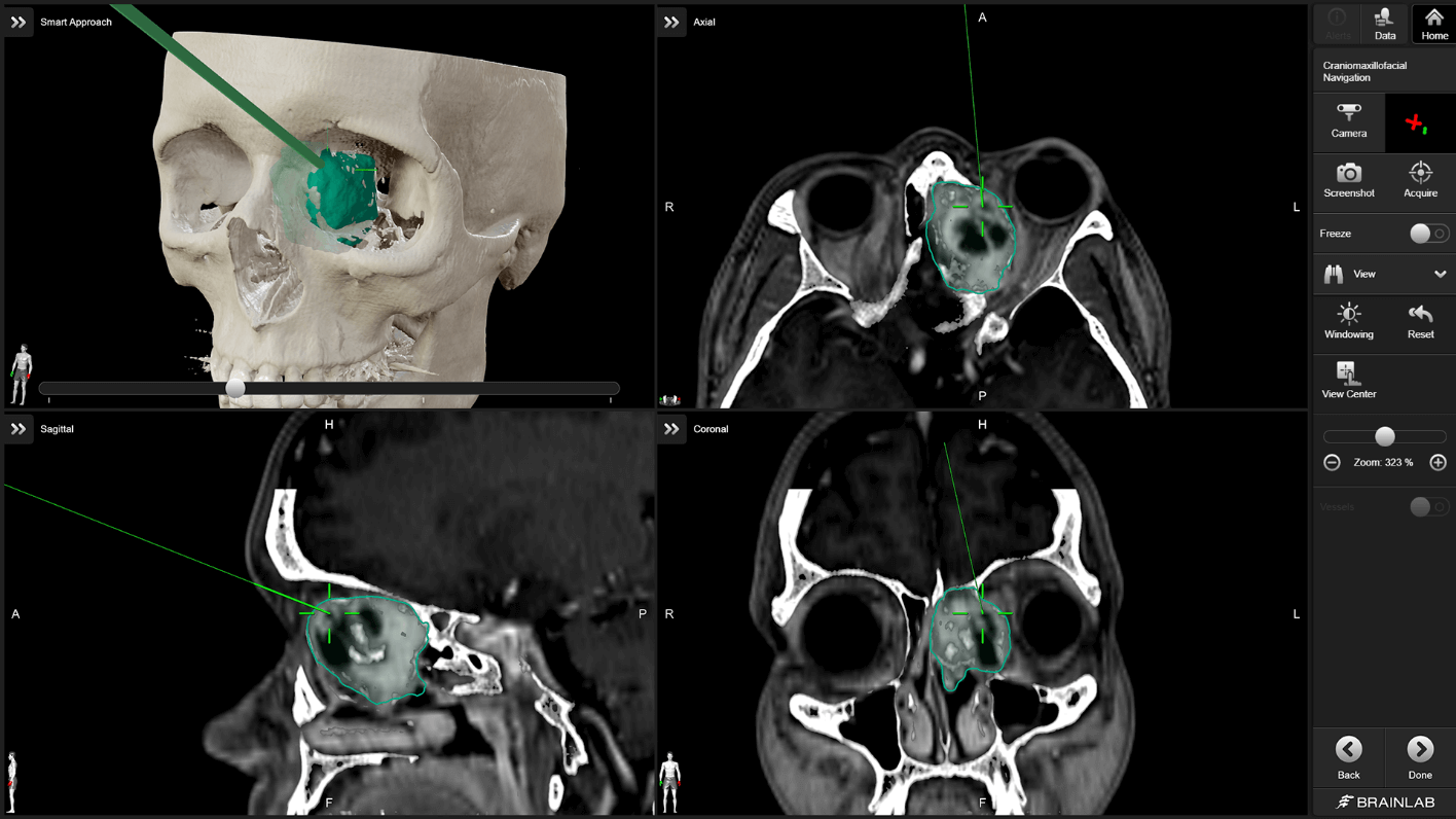 CMF Surgery Navigation: Craniomaxillofacial Surgery | Brainlab